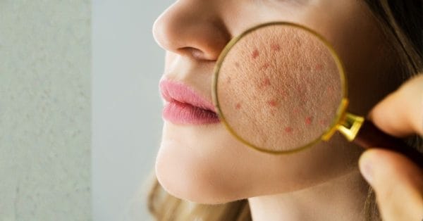 Akneye Eğilimli Ciltler İçin Defne Yaprağı Özlü Akne Önleyici Set ve Günlük Bakım