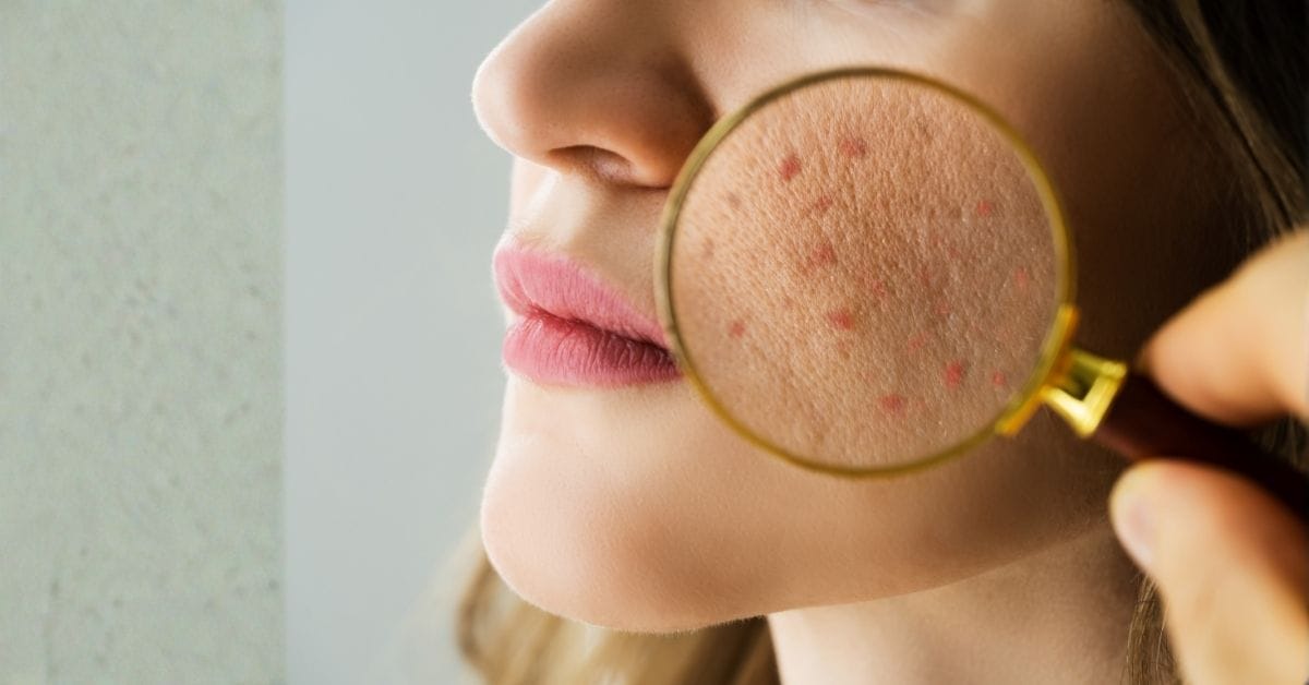 Akneye Eğilimli Ciltler İçin Defne Yaprağı Özlü Akne Önleyici Set ve Günlük Bakım