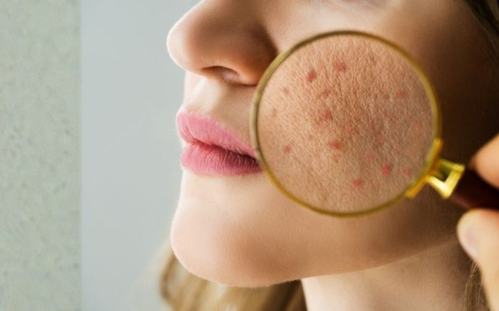 Akneye Eğilimli Ciltler İçin Defne Yaprağı Özlü Akne Önleyici Set ve Günlük Bakım